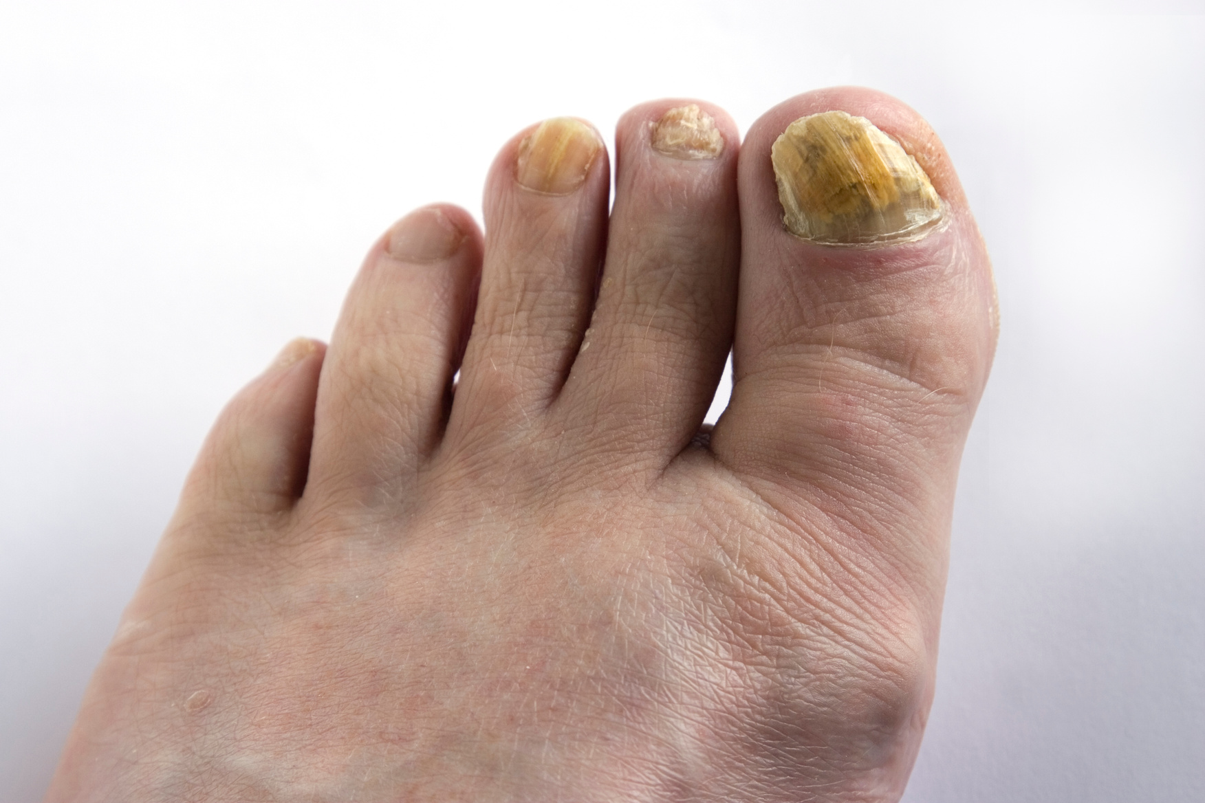 Winter Foot Problems You Shouldn't Ignore (And How to Fix Them Before Spring)